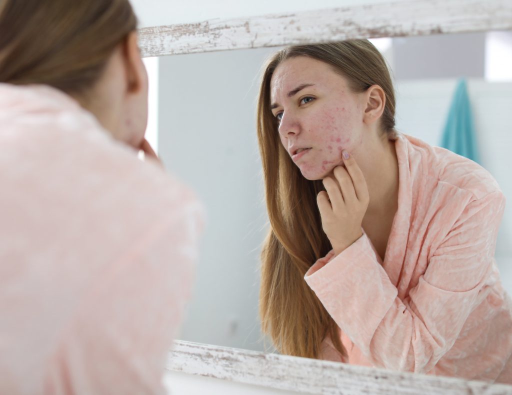Acne. acne skincare. acne prone. skin. skin care. face. skincare. Skincare Tips. Healthy skin. Natural. Skincare Products. skincare tips. Natural Skincare. acneic skin. Benzoyl Peroxide. Benzoyl Peroxide products