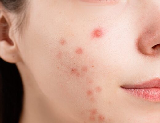acne. acne treatment. cystic acne. skin treament. skin care. supplements for acne.