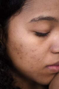 woman. dark spots. skin . woman skin. acne. acneic skin. spots . acne prone . skincare . skin care . Healthy skin. Natural. Skincare Products. Natural Skincare. 