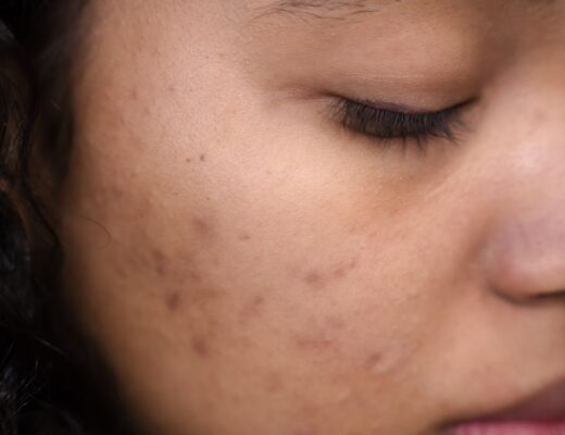 Acne. acne skincare. acne prone. skin. skin care. face. skincare. Skincare Tips. Healthy skin. Natural. Skincare Products. skincare tips. Natural Skincare. acneic skin. Mandelic acid. Mandelic products. AHA. hyperpigmentation.