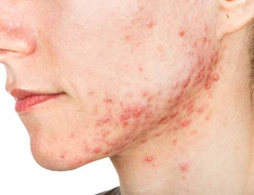 painful breakout, acne, cystic acne, hormonal acne