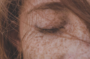 Freckles , eye