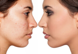 acne, acne treatment, diy acne treatment 
