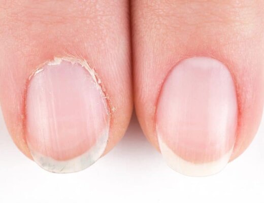 cuticle care, dry nails