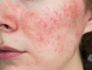 woman, skin Irritation