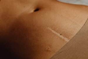 scar, skin