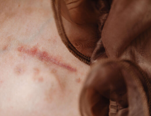 scar, skin