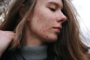 woman, acne, scars