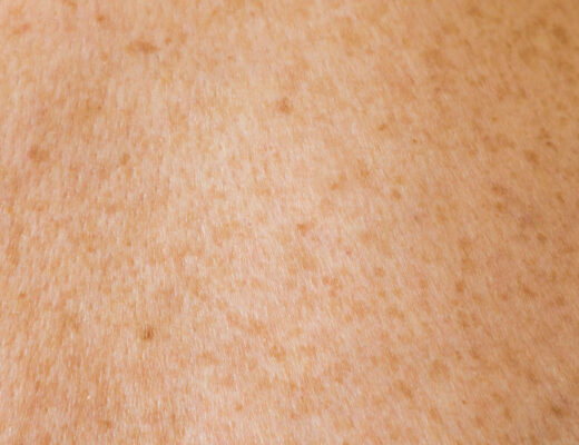 skin, moles