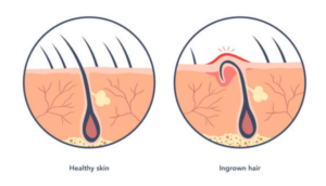 ingrown hair, hair